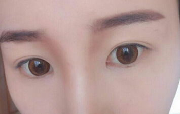达美整形邢文明做的全切双眼皮+开内眼角