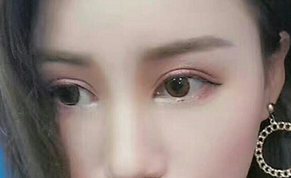 达美整形邢文明做的全切双眼皮+开内眼角