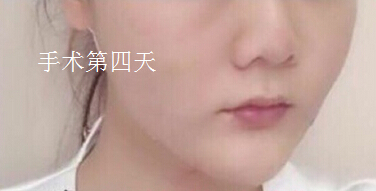 长沙伊美唐中华做的面部吸脂和脂肪填充下巴