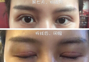 武汉协和孙家明医生做的全切双眼皮