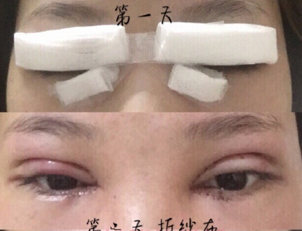 广州中山三院胡瑛医生做的全切+眼角