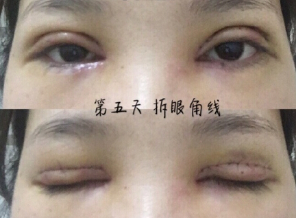 广州中山三院胡瑛医生做的全切+眼角