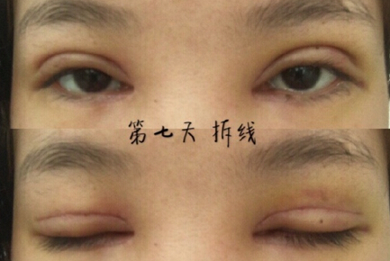广州中山三院胡瑛医生做的全切+眼角