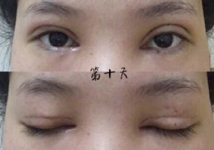 广州中山三院胡瑛医生做的全切+眼角