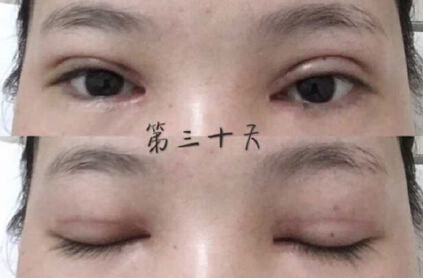 广州中山三院胡瑛医生做的全切+眼角