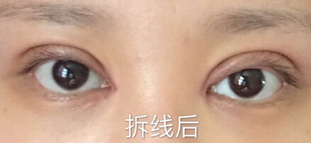 山东某城市某医院做的全切双眼皮+内眼角