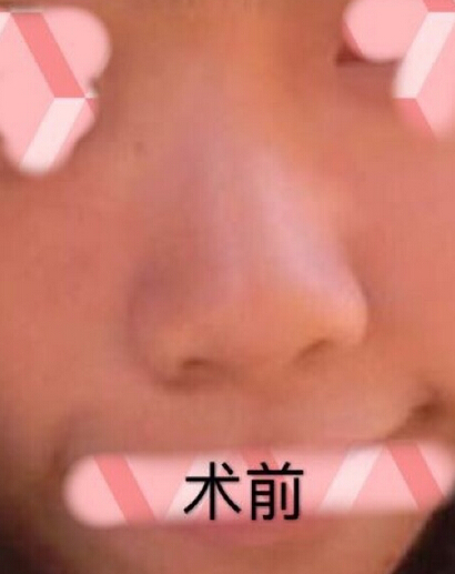 做的鼻部手术,硅胶+鼻中隔+耳软骨