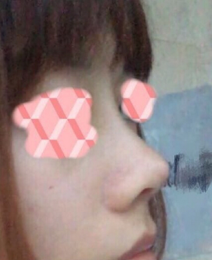 做的鼻部手术,硅胶+鼻中隔+耳软骨