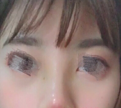 做的鼻部手术,硅胶+鼻中隔+耳软骨
