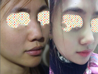 郭宗科做的鼻部手术,硅胶鼻假体+耳软骨鼻尖