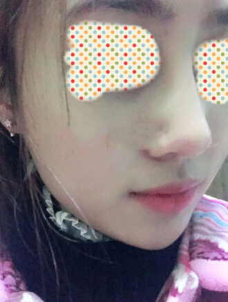 郭宗科做的鼻部手术,硅胶鼻假体+耳软骨鼻尖