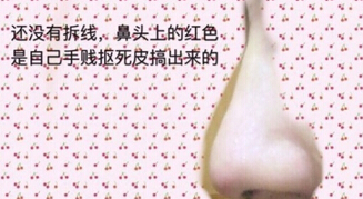 八大处尤建军医生做的肋软骨鼻部手术