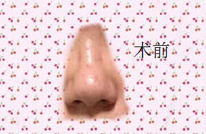 八大处尤建军医生做的肋软骨鼻部手术