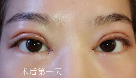 长沙爱思特陈杰医生做的双眼皮
