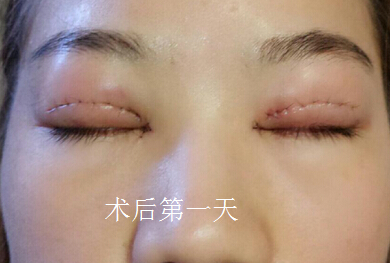 长沙爱思特陈杰医生做的双眼皮