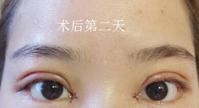 长沙爱思特陈杰医生做的双眼皮