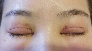 长沙爱思特陈杰医生做的双眼皮