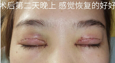 长沙爱思特陈杰医生做的双眼皮