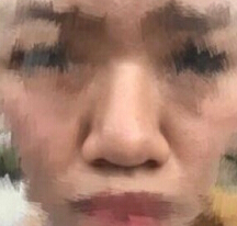想做鼻子,不知道怎么抉择