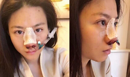 哈尔滨艺星曲主任做的鼻部手术手术