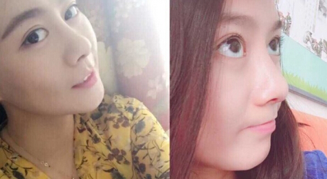 哈尔滨艺星曲主任做的鼻部手术手术