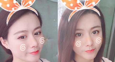 哈尔滨艺星曲主任做的鼻部手术手术