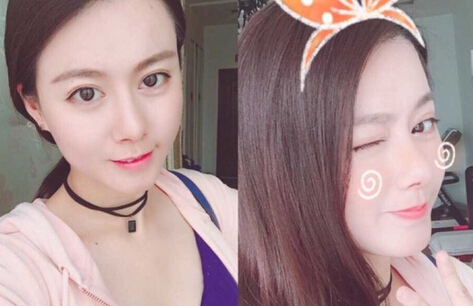哈尔滨艺星曲主任做的鼻部手术手术