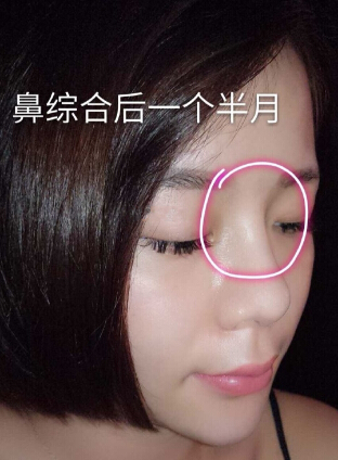 在衢州一家医院做的鼻部手术