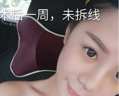 在衢州一家医院做的鼻部手术