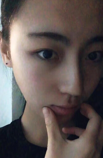 做完双眼皮觉得肉条,假深,觉得失败了