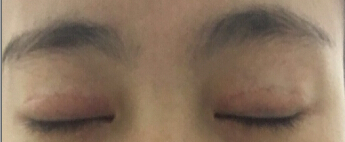 做完双眼皮觉得肉条,假深,觉得失败了
