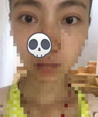 做完双眼皮觉得肉条,假深,觉得失败了