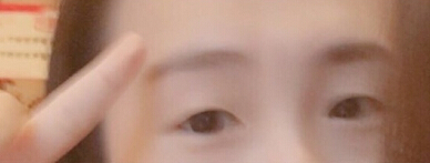 重庆华美整形医院做的埋线双眼皮+去脂