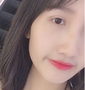 重庆华美整形医院做的埋线双眼皮+去脂