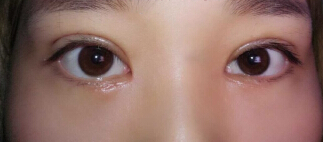 成都娇点医生李竞做的双眼皮+开眼角+提肌