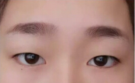 成都娇点医生李竞做的双眼皮+开眼角+提肌