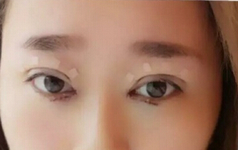 成都娇点医生李竞做的双眼皮+开眼角+提肌