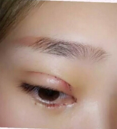 成都娇点医生李竞做的双眼皮+开眼角+提肌