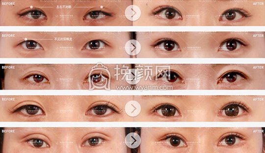 ***教授眼部修复