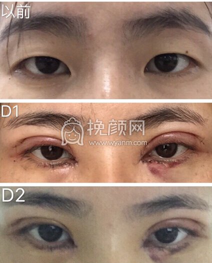 八大处王永前全切+内眼角