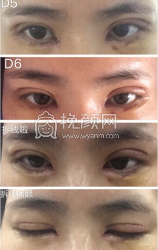 八大处王永前全切+内眼角