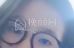 八大处王永前全切+内眼角