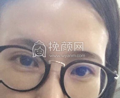 八大处王永前全切+内眼角