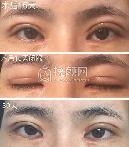 八大处王永前全切+内眼角