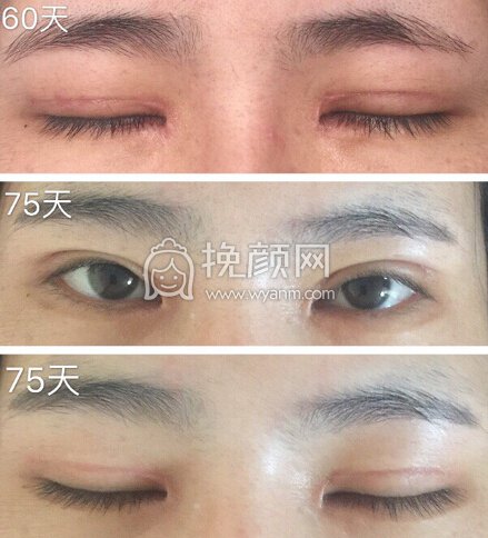 八大处王永前全切+内眼角