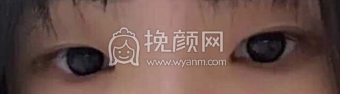 铜雀台陈远琨医生做的双眼皮+开眼角+提肌