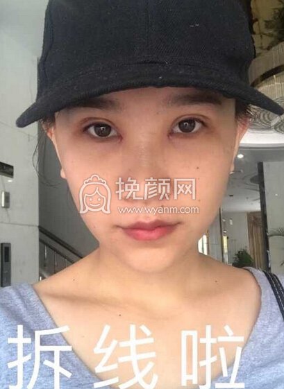 海南皮肤病医院焦仕程做的双眼皮+开眼角