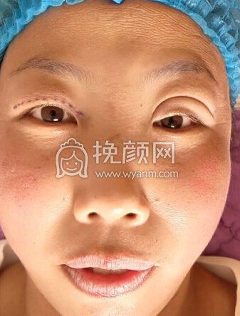 做双眼皮还是要到正规机构才放心