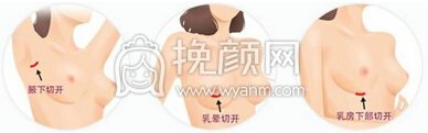 北京假体丰胸手术后的果好吗
