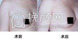 北京副乳切除手术的价钱是多少